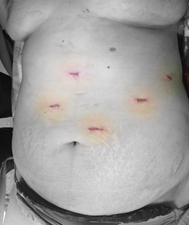 LAPAROSKOPİK REFLÜ OPERASYONU CİLT KESİLERİ