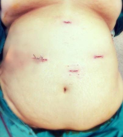 TÜP MİDE OPERASYONU CİLT KESİLERİ